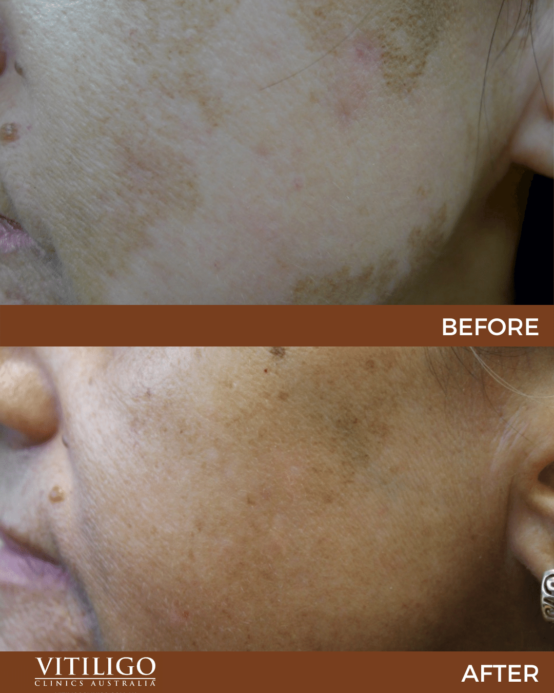 Light Therapy For Vitiligo Before And After At Bonnie Call Blog