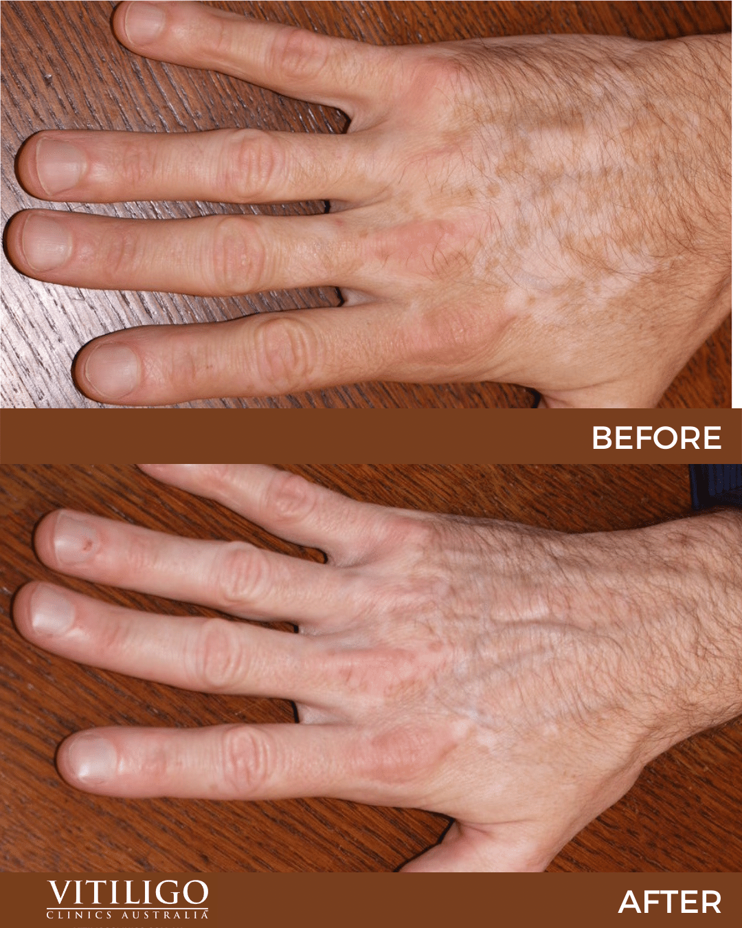 Vitiligo Mayo Clinic Treatment PESY