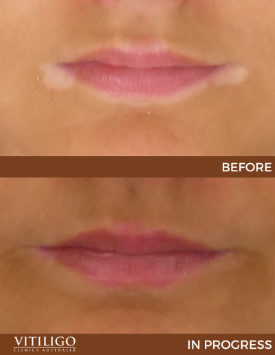 A before-and-after image of a patient receiving vitiligo treatment on lip corners