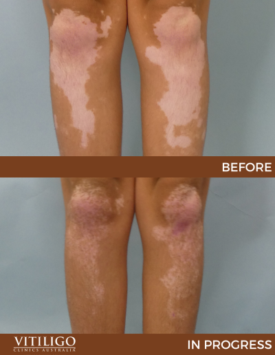 A before-and-after image of a patient receiving vitiligo treatment on knees and shin