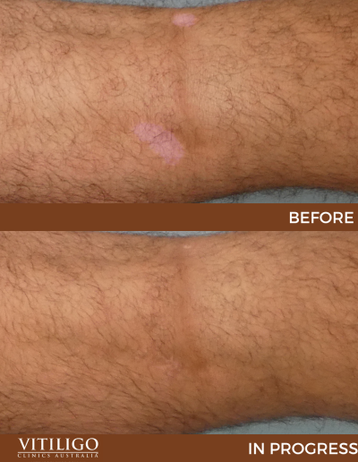 A before-and-after image of a patient receiving vitiligo treatment on the back of knee