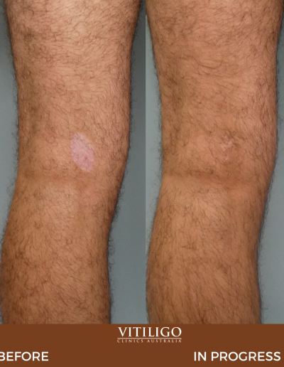 A before-and-after image of a patient receiving vitiligo treatment on the back of knee