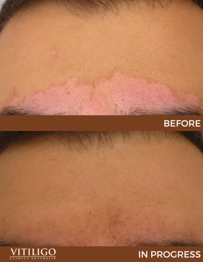 A before-and-after image of a patient receiving vitiligo treatment on eyebrows