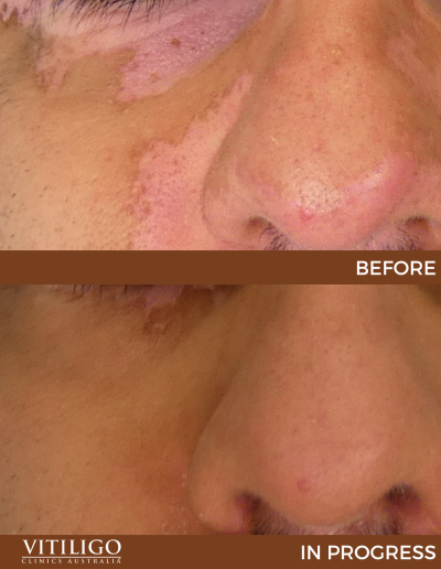 A before-and-after image of a patient receiving vitiligo treatment on nose and eyebags