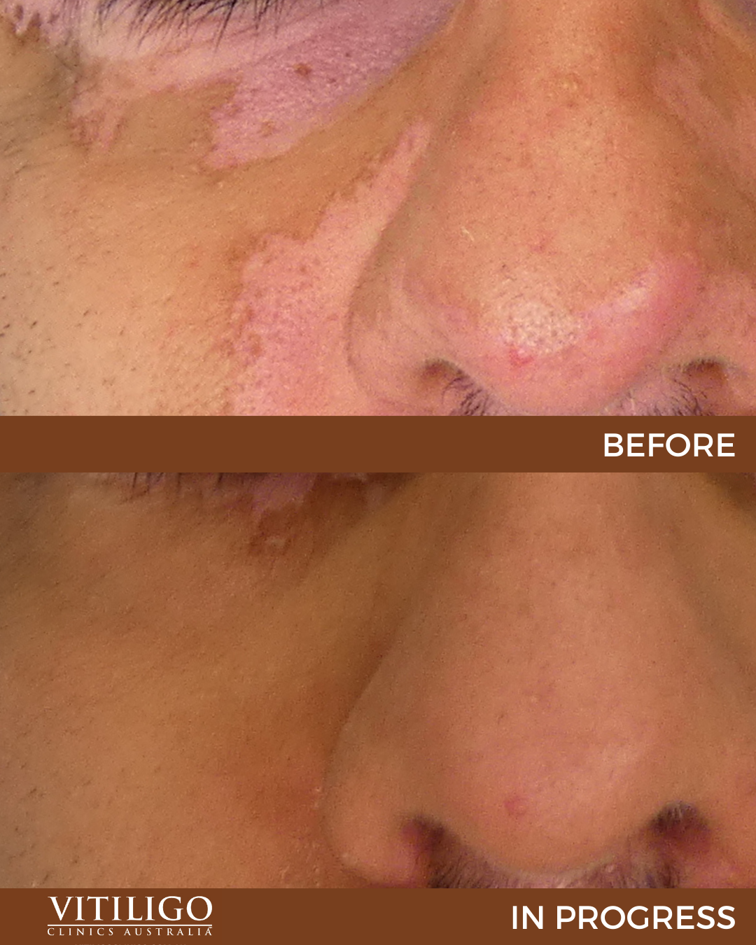 Light Therapy For Vitiligo Before And After At Bonnie Call Blog