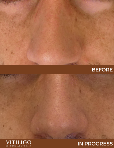 A before-and-after image of a patient receiving vitiligo treatment on eyebags and nose