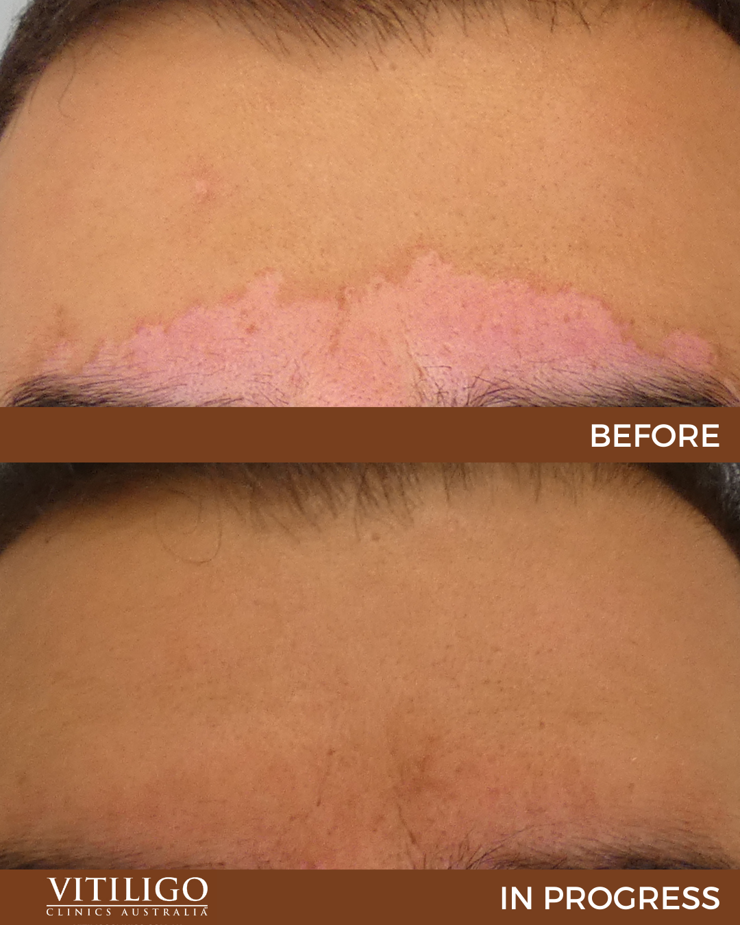 Light Therapy For Vitiligo Before And After At Bonnie Call Blog