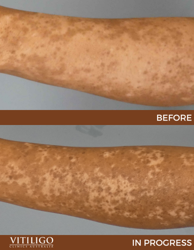 A before-and-after image of a patient receiving vitiligo treatment on arm