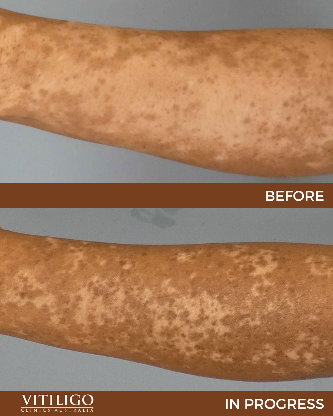 research on vitiligo cure