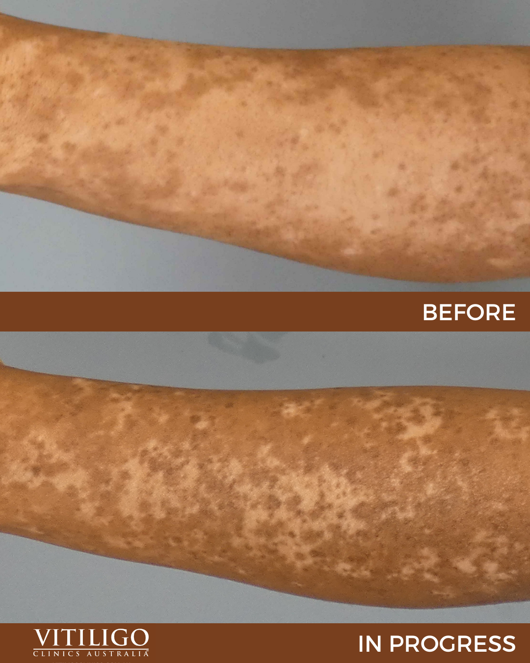 Doctolib Sp cialiste Vitiligo Vitiligo Definition GWGK