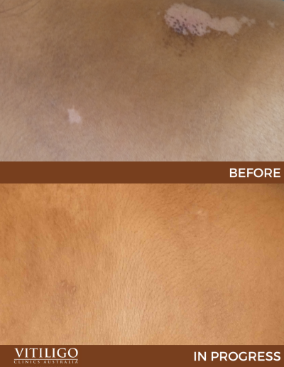 A before-and-after image of a patient receiving vitiligo treatment on back