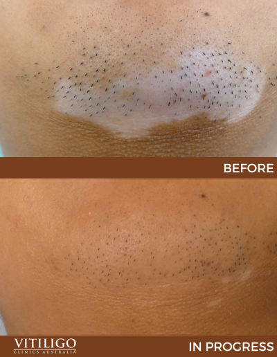 A before and after image of a patient receiving vitiligo treatment on chin