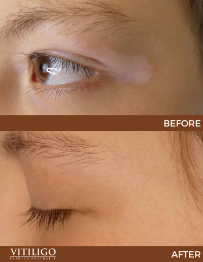 A before-and-after image of a patient receiving vitiligo treatment on eyelid corner