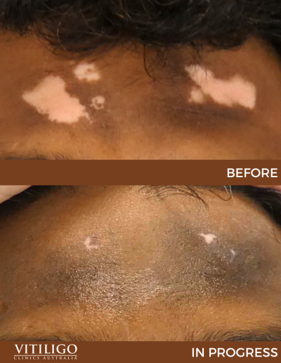 A before-and-after image of a patient receiving vitiligo treatment on forehead