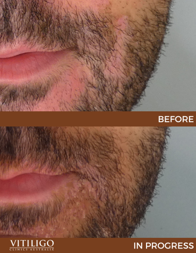 A before-and-after image of a patient receiving vitiligo treatment on lower face