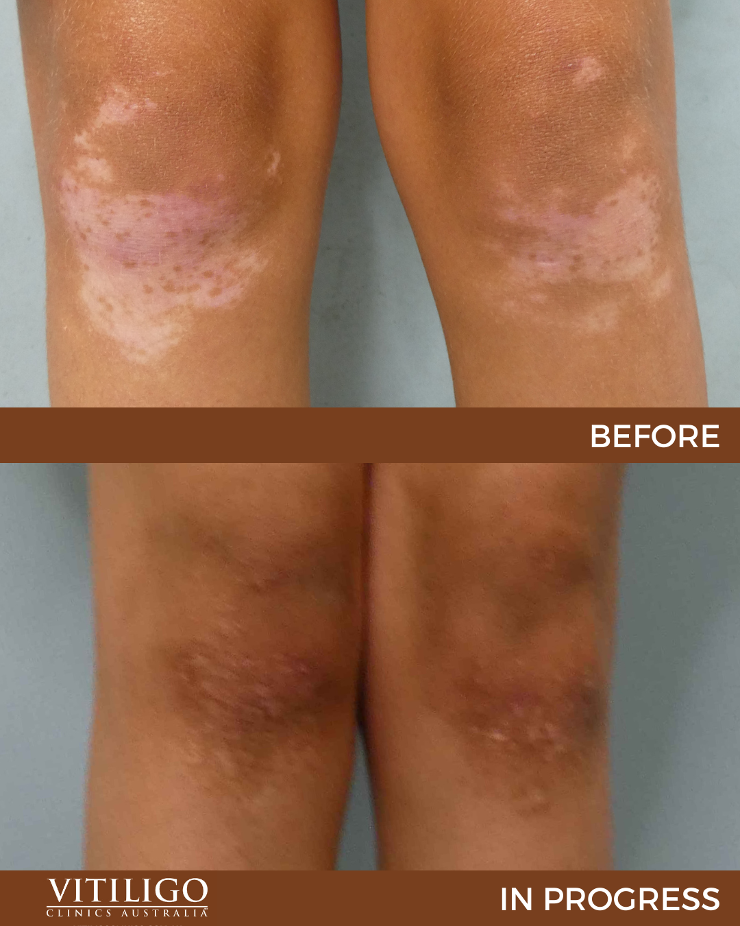 Vitiligo Before and After Treatment Vitiligo Clinics Australia