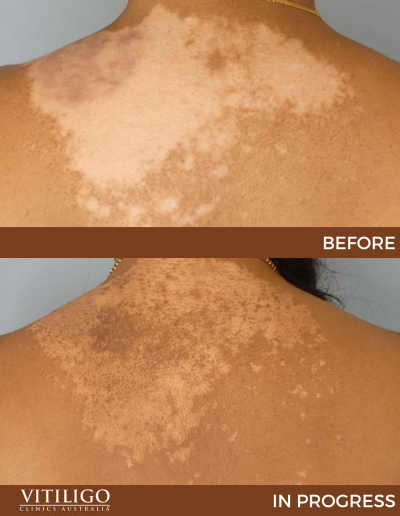 A before-and-after image of a patient receiving vitiligo treatment on upper back